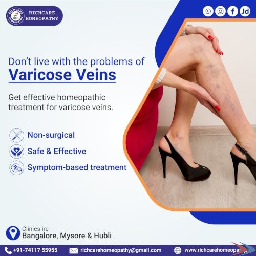 Homeopathic Medicine & Treatments for Varicose Veins