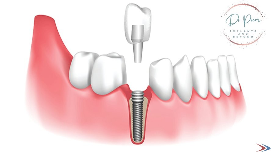 Investing in Confidence: The Journey of All-on-4 Implants